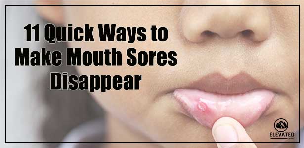 Mouth sores, how to get rid of mouth sores, canker sores, get rid of canker sores