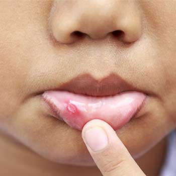 mouth sores, canker sores, how to get rid of canker sores, get rid of mouth sores, cold sores, how to get rid of cold sores, make cold sore go away