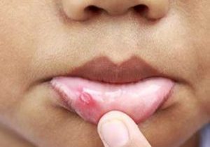 mouth sores, canker sores, how to get rid of canker sores, get rid of mouth sores, cold sores, how to get rid of cold sores, make cold sore go away